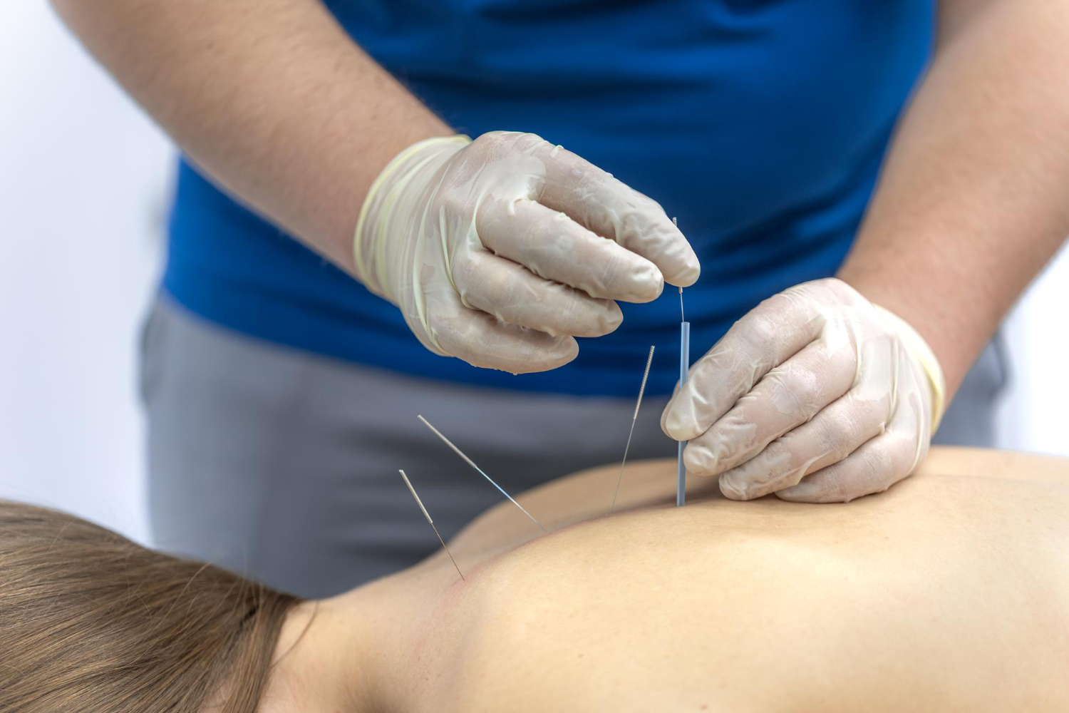 Pain Relief Acupuncture